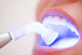 teeth whitening